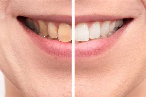 Holistic Teeth Whitening Considered Safe By Experts