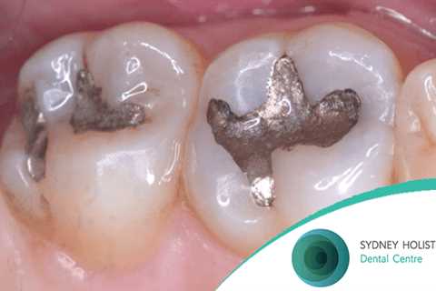 Sydney Holistic Dental Practice Has Established a Reputation for Safe Mercury Amalgam Filling..