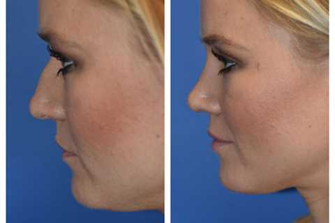 Rhinoplasty Belleve WA