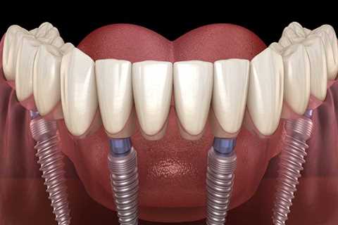 Are implants considered orthodontic?