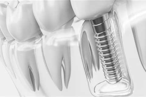 Dental Assistants Role In A Dental Implant Procedure In Texas