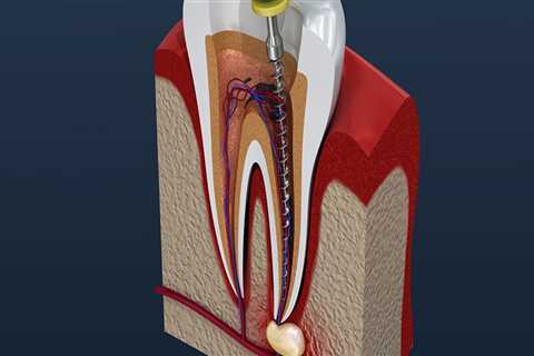 Do I Need a Dental Crown After a Root Canal?