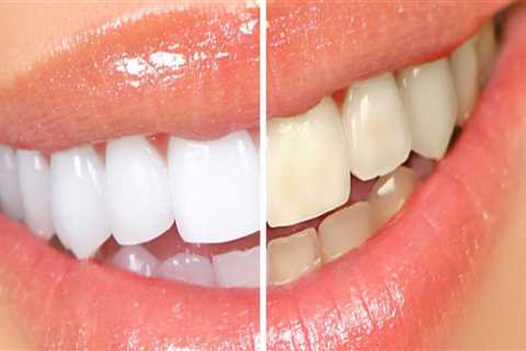 What Type of Dental Supplies are Used for Tooth Whitening Treatments?