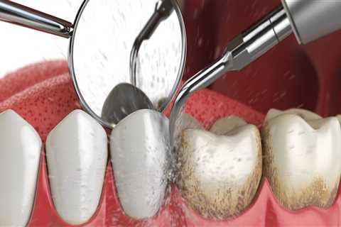 What Type of Dental Supplies are Used to Clean Teeth?