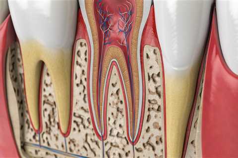 Treating an Infected Tooth Bone: A Comprehensive Guide