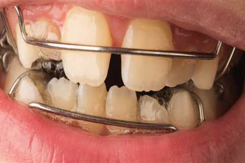 What is the Difference Between Primary and Permanent Molars Roots?