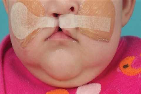 Caring for Children with Cleft Lip and Palate: A Pediatric Dentist's Perspective