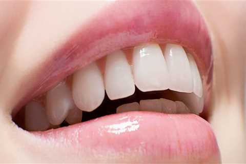 Maintaining White Teeth After Professional Treatment: Supplements to the Rescue