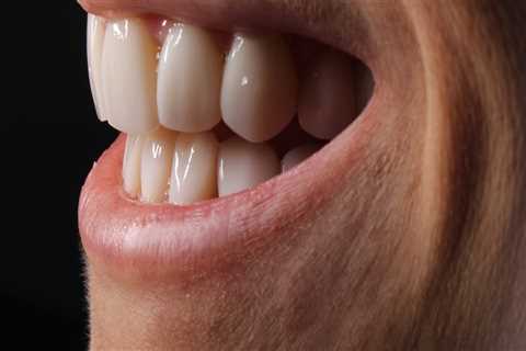 Can I Whiten My Teeth with Veneers? - A Guide from an Expert