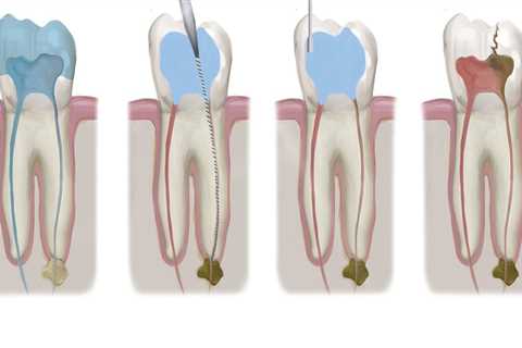 Preparing for an Endodontic Appointment: What You Need to Know