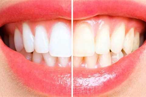 Can Baking Soda Whiten Your Teeth? Expert Advice on How to Brighten Your Smile