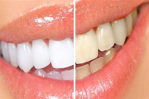 What Teeth Cannot Be Whitened? A Comprehensive Guide