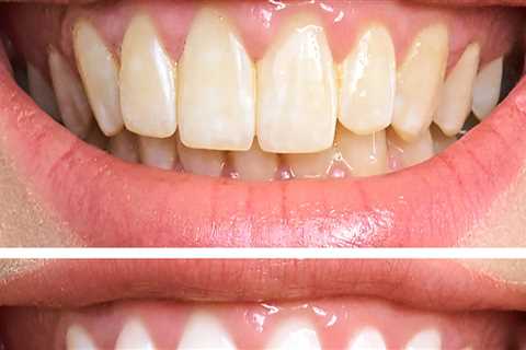 Maintaining a Bright Smile After Professional Teeth Whitening