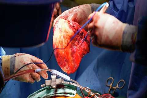 Heart Transplantation in Central Texas: What You Need to Know