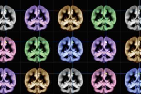 Study Finds Markers Of ADHD In MRI Scans: 'Changes In Almost All Regions Of Brain'