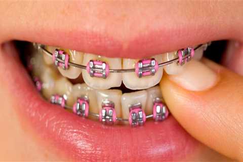 Protecting Your Smile After Invisalign Orthodontics Treatment In San Antonio