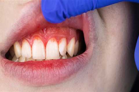 What Does Periodontal Disease Feel Like?