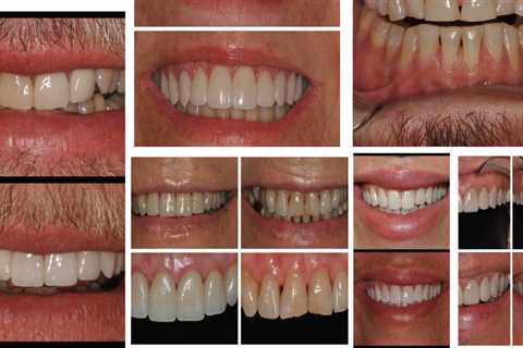 What are Dental Veneers and How Can They Improve Your Smile?