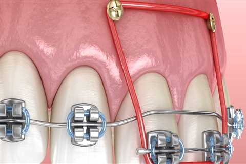 Why Orthodontists are the Best Choice for Your Oral Health