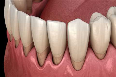 What is a Gum Graft? A Comprehensive Guide