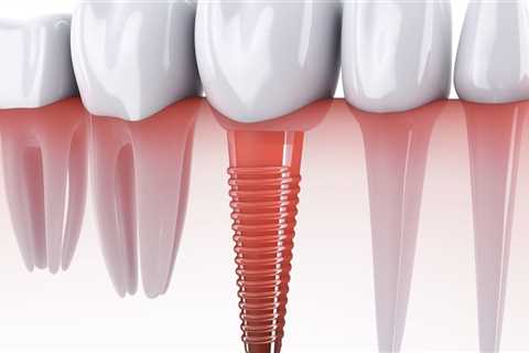 Transform Your Smile With Dental Implants: A Game-Changer For Missing Bicuspids In San Antonio