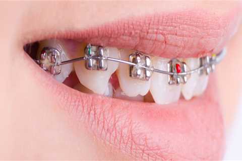 What is the Cost of Braces at a Dentist in Fairhope, Alabama?