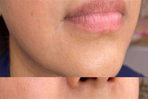 Why Medical Spas Use Medical Professional Networking To Ensure The Best Lip Filler Results For..