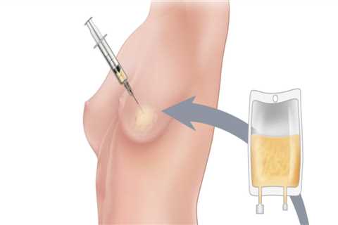 Unlocking Your Body's Potential: How A Health Consultant Can Enhance Your Fat Grafting Experience..