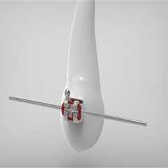 Understanding Periodontics and Metal Braces in Hartsdale